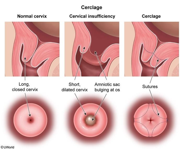transabdominal cerclage Raipur
